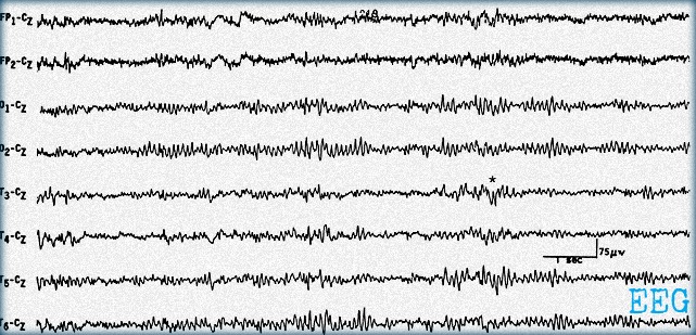 EEG Results Are In